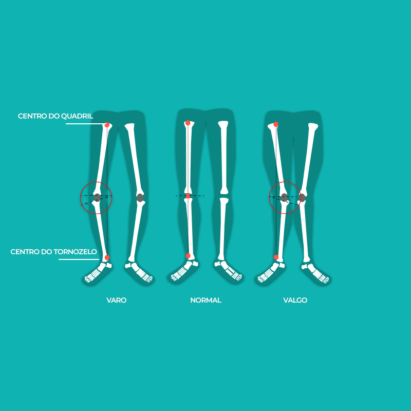 Joelho torto: saiba como identificar e tratar joelho varo ou valgo