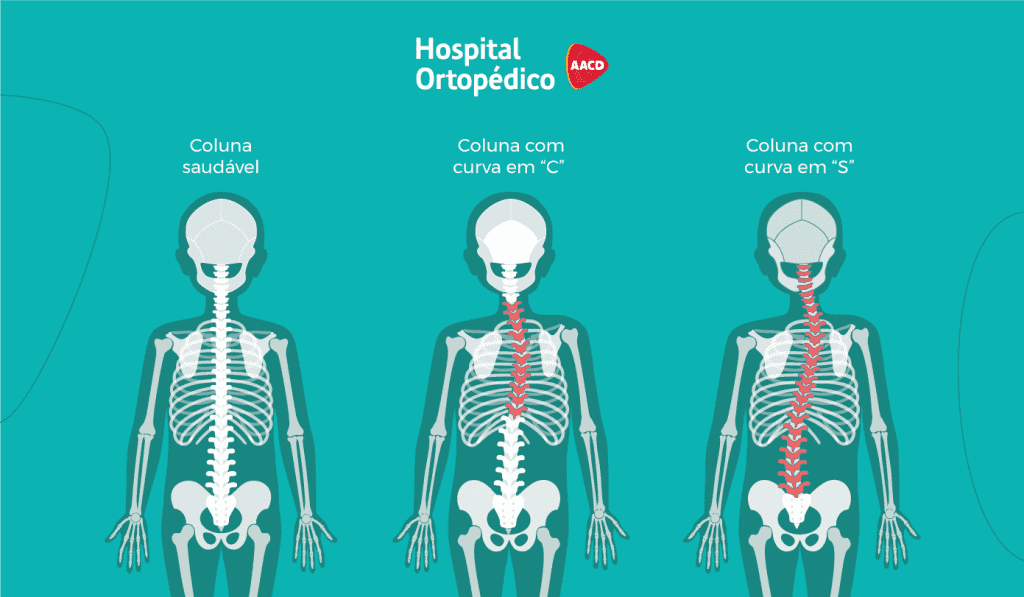 Nesta imagem você confere as curvas em "S" e "C" características da Escoliose