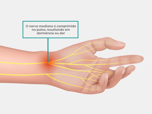 A síndrome do túnel do carpo é causada pela compressão do nervo mediano