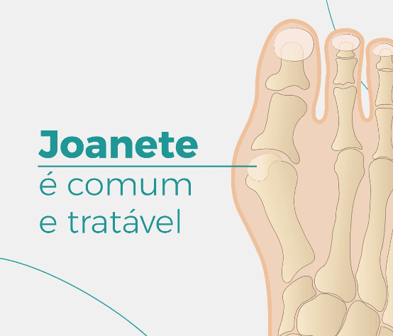 O joanete é comum e tratável.