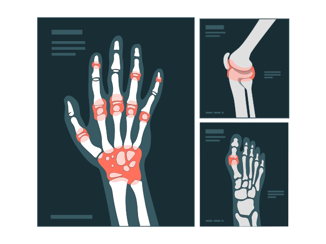 A artrite acomete as articulações em diversas regiões do corpo humano