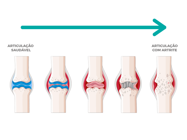 As articulações são extremamente prejudicadas por causa da artrite
